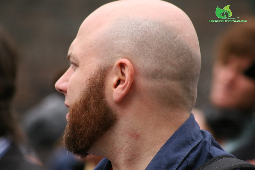 How to Grow Hair on Bald Head? Effective Home Remedies