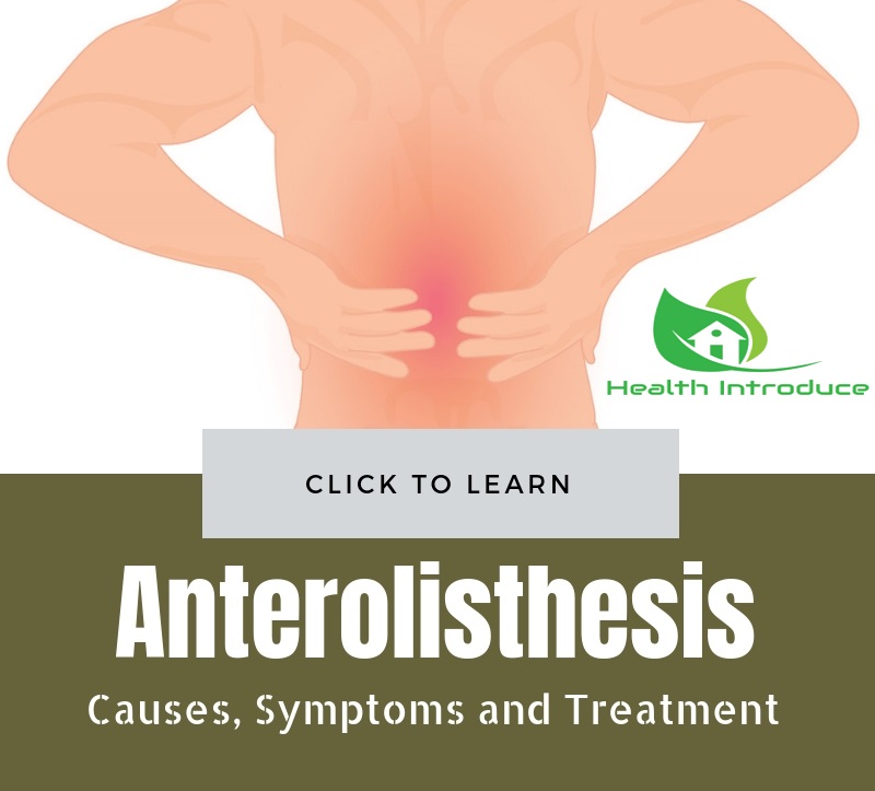 Anterolisthesis: Symptoms, Causes, Types, Diagnosis, Treatment
