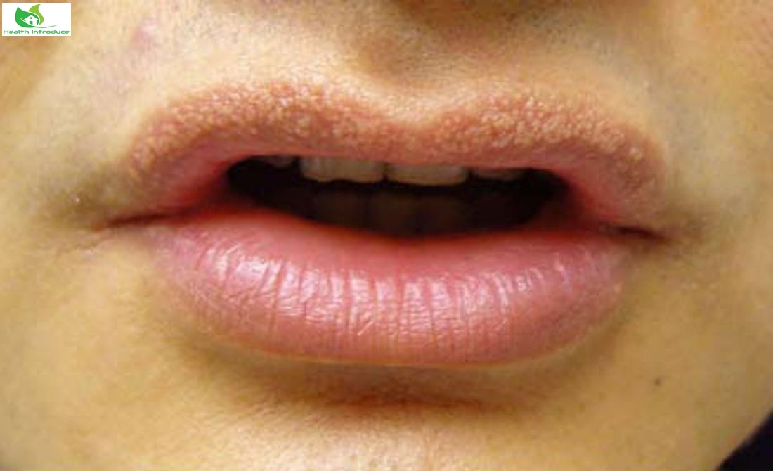 White Spots on Lips - Symptoms, Causes & How to Get Rid of it?